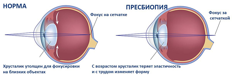 пресбиопия