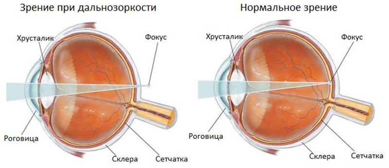 зрение при дальнозоркости